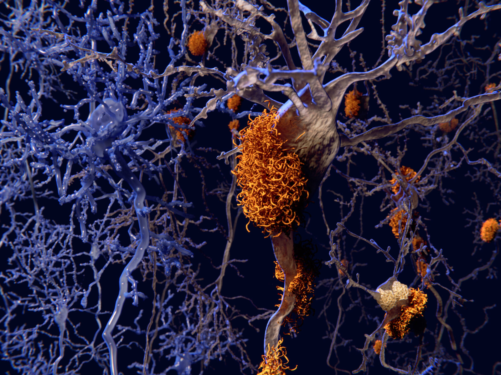 Neurons with amyloid plaques compared to healthy neurons. Amyloid plaques accumulate outside neurons. Amyloid plaques are characteristic features of Alzheimer's disease. They lead to a degeneration of the affected neurons, that are destroyed through the activity of microglia cells.